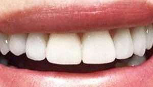 porcelain veneers after