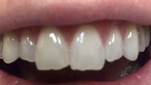 porcelain veneers before