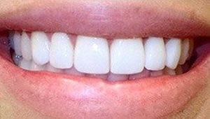 porcelain veneers after