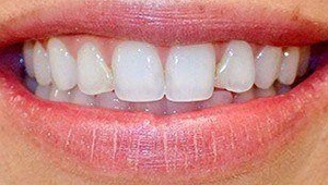 porcelain veneers before