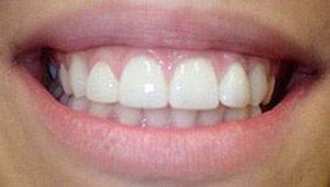 porcelain veneers after