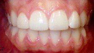 porcelain veneers after