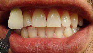 before teeth whitening