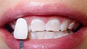 after teeth whitening