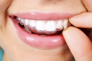 Invisalign Process