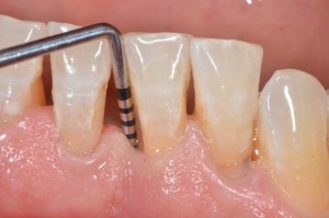 periodontal disease costa mesa dentist advanced dental care best dentist in orange county