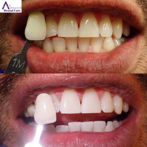 Dr. Jeremy Jorgenson - Costa Mesa Dentist - Emergency Dentist - Saturday Dentist - Dental Crowns - Dental Bridges - Dental Implants - Invisalign - Veneers - Teeth Whitening - implant & cosmetic dentistry