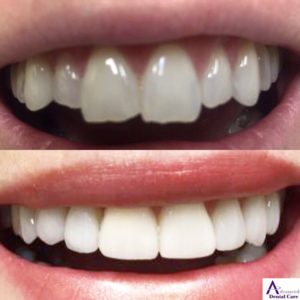 dental veneers - porcelain veneers - cosmetic dentistry - best dentist costa mesa - newport beach - orange county - best dentist open now - saturday dentist - costa mesa dentist - invisalign - delta dental - metlife dental - cigna dental - guardian dental