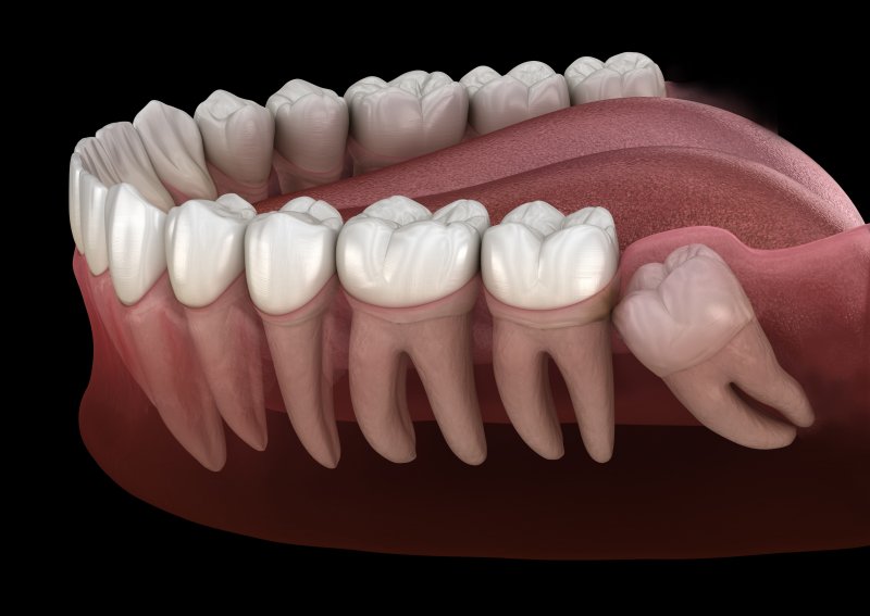 Impacted wisdom teeth