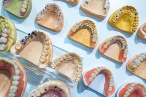 several different models of mouths with traditional dentures, implant dentures, and other prosthetics on them