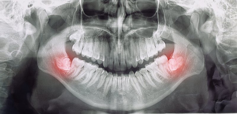 dental X-ray of wisdom teeth