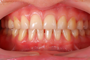 close-up of gums