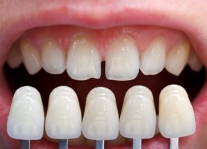 Veneers compared to imperfect teeth.