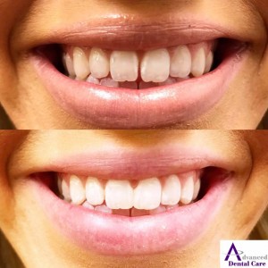 tooth bonding - composite - cosmetic dentistry - cosmetic dentist - costa mesa - newport beach - irvine - oc