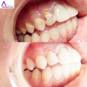 tooth bonding - composite - cosmetic dentistry - cosmetic dentist - costa mesa - newport beach - irvine - oc