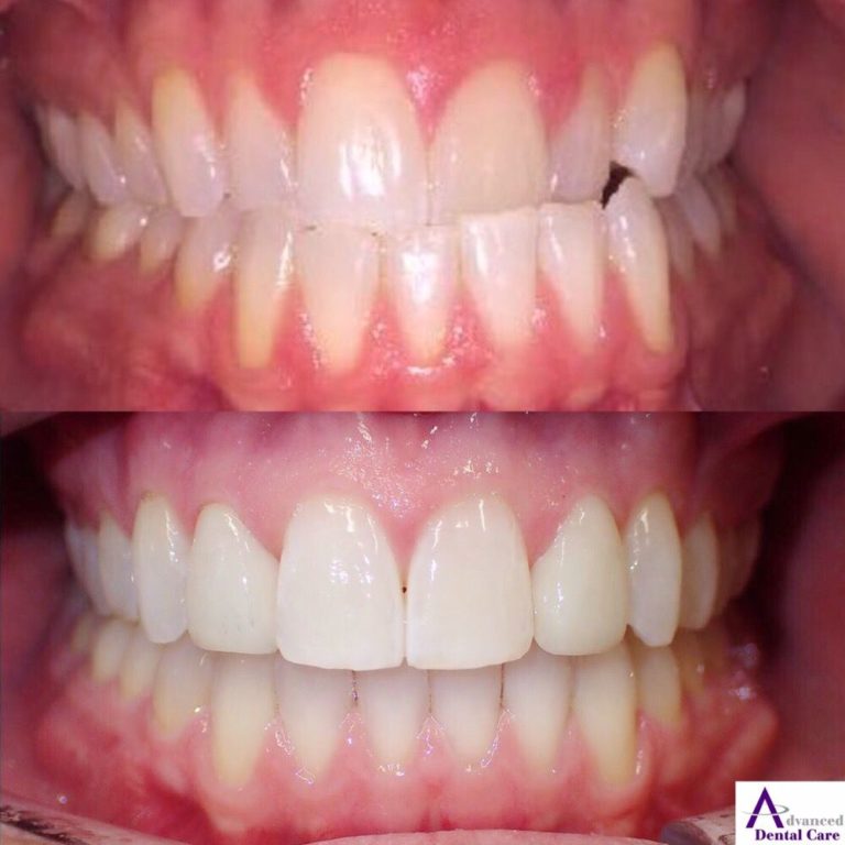 Invisalign Costa Mesa Dentist Orthodontics Cosmetic Dentistry