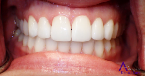 Porcelain Veneers - Prepped Teeth - Cosmetic Dentistry - Costa Mesa - Advanced Dental Care