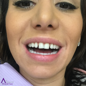 Porcelain Veneers - Prepped Teeth - Cosmetic Dentistry - Costa Mesa - Advanced Dental Care