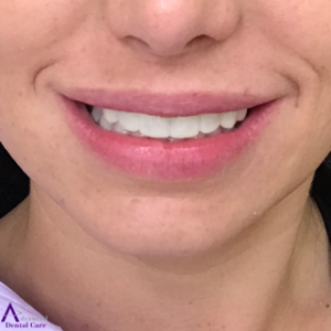 Porcelain Veneers - Temporary Veneers - Cosmetic Dentistry - Costa Mesa - Advanced Dental Care