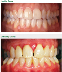 Summit-dental-2013-08-healthy-gums