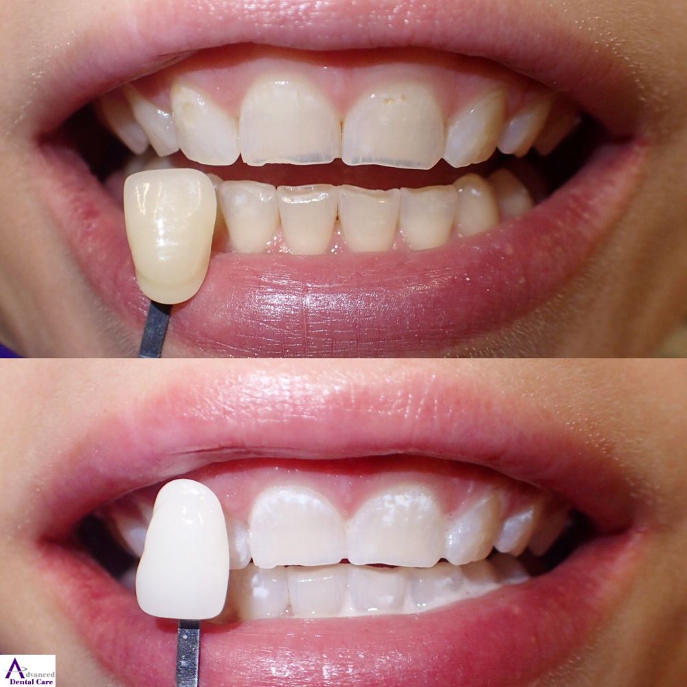 Dr. Jeremy Jorgenson - Costa Mesa Dentist - Emergency Dentist - Saturday Dentist - Dental Crowns - Dental Bridges - Dental Implants - Invisalign - Veneers - Teeth Whitening