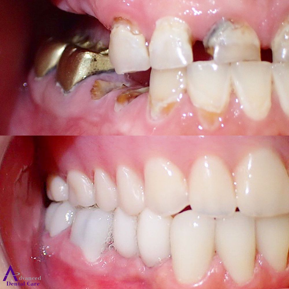 advanced dental care - missing tooth - dental implants costa mesa - dental  bridge costa mesa - dental crowns costa mesa - dentist costa mesa - costa mesa dentist - ppo dentist - dentist open now - emergency dentist - missing teeth 