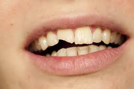 chipped tooth - cracked tooth - broken tooth - front tooth - best dentist costa mesa - emergency dentist - ppo dentist - no insurance dentist - saturday dentist