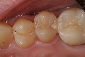 cavity tooth pain costa mesa dentist