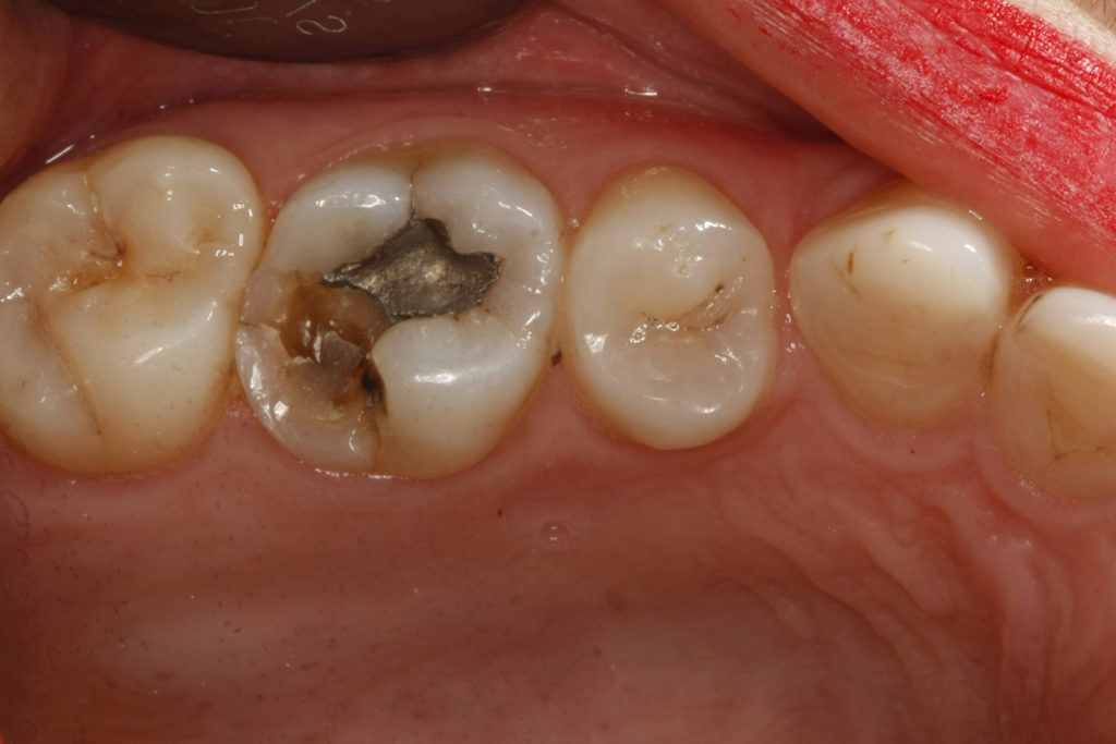 Help! I have a Broken Tooth. Do I need Emergency Dental Care?