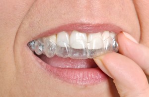 invisalign in costa mesa