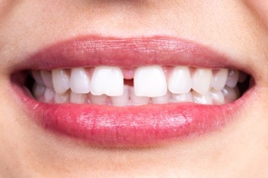 closeup of a smile with diastema 