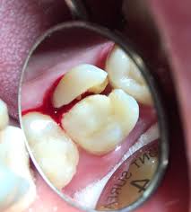 cracked tooth - emergency dental - dental emergency - dentist open now - dentist near me - bleeding tooth - tooth pain - chipped tooth