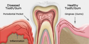 Gum Disease costa mesa ca