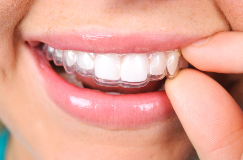 teeth whitening trays and bleaching gel - at home teeth whitening