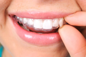 Invisalign clear braces 