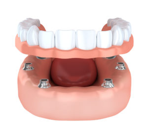 Do you know what could happen if you don’t get dental implants in Costa Mesa in place of a lost tooth?