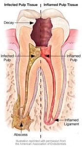 infected-inflamed-pulp-tissue