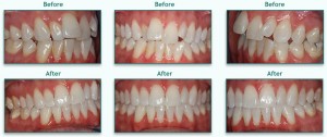 Invisalign Before and After