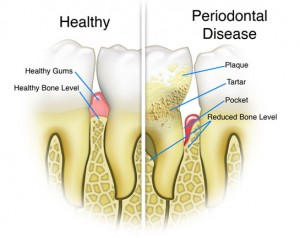 periodontal-disease