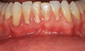 periodontal-disease -boneloss