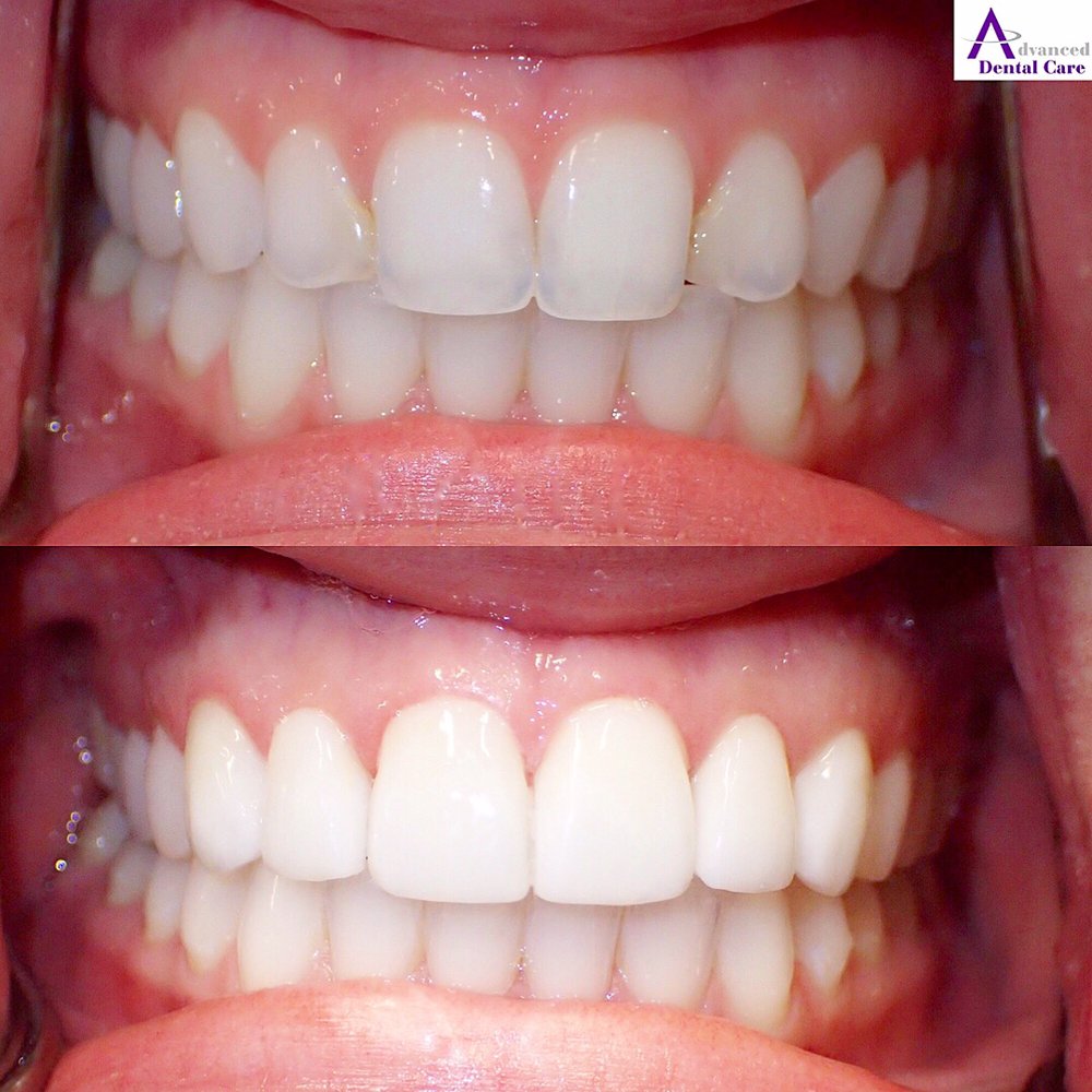 porcelain veneers