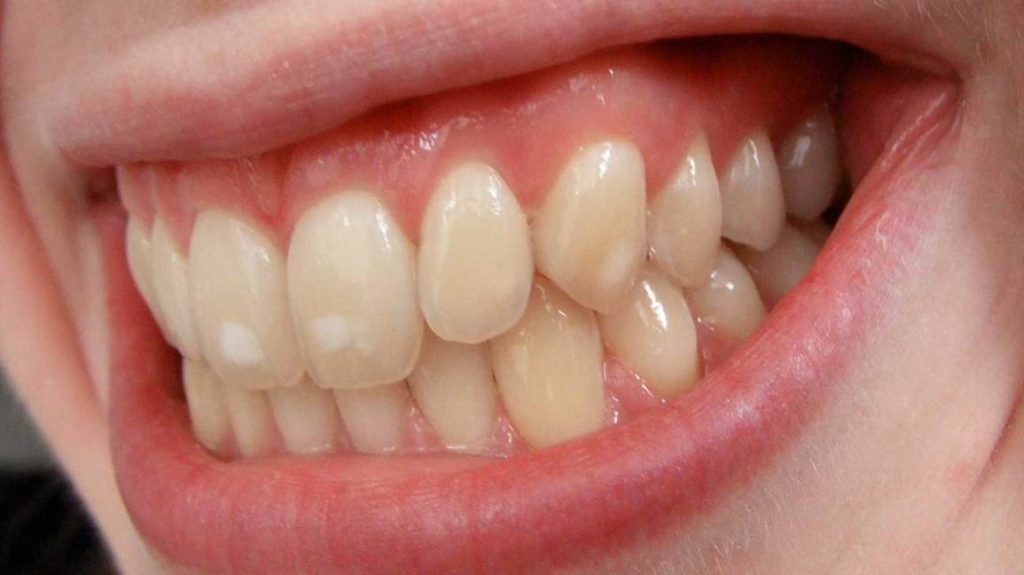 white-spots-teeth-dental-fluorsis-calcification-cosmetic-dentristry-costa mesa -best dentist near me - dentist costa mesa - dentist open now
